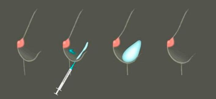 Élargissement du sein à travers des injections hyaluronées