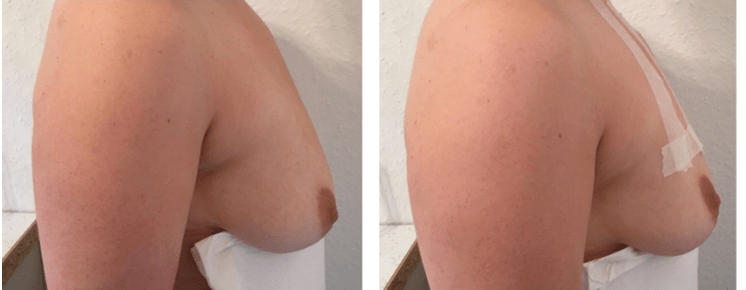 Avant et après lifting des seins avec fil