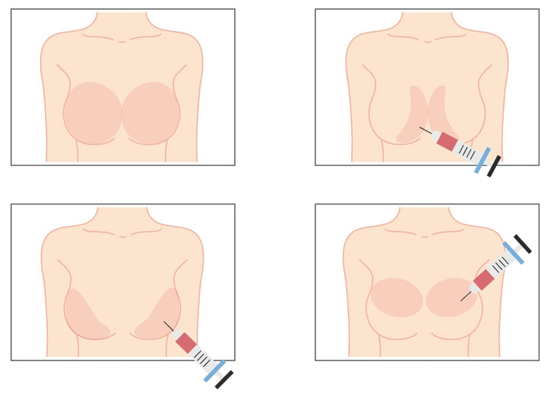 Lieux d'injection d'acide hyaluronique dans le sein
