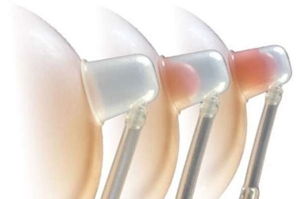 Bonnets correcteurs pour allonger et agrandir les mamelons