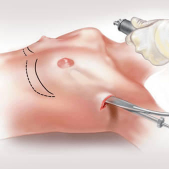 Augmentation mammaire endoscopique