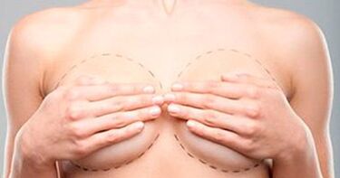 Marquage des seins avant le lifting et l'augmentation